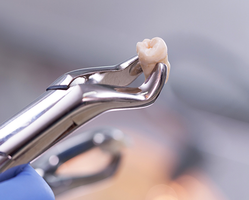 Forceps holding tooth after tooth extraction