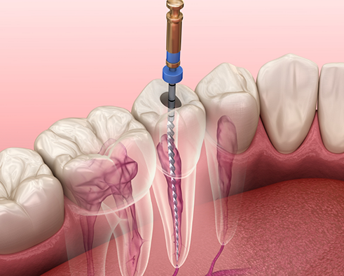 Illustration of root canal treatment
