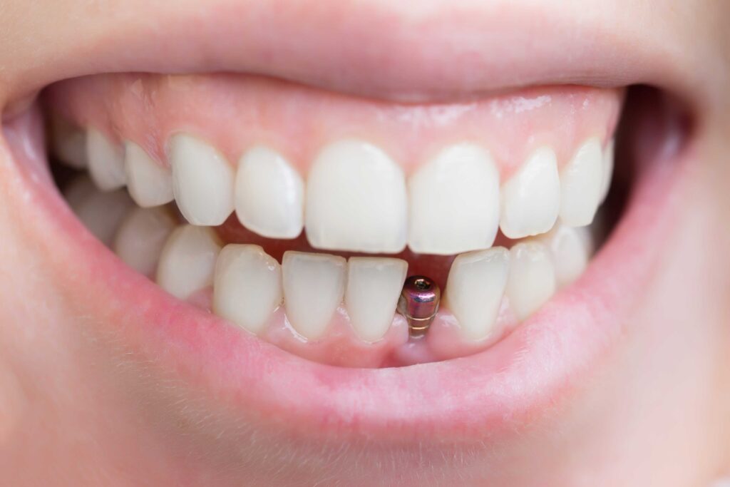 Closeup of a woman with a dental implant smiling