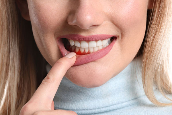 Woman pointing to swollen gums indicating gum disease, emphasizing the importance of periodontal maintenance for healthy gums at Kimberley Lane Cosmetic and Family Dentistry in Houston.