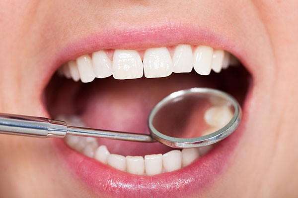 Close-up of a patient's mouth during a dental examination, showcasing healthy teeth and gums, with a dental mirror and explorer tool used for periodontal maintenance.