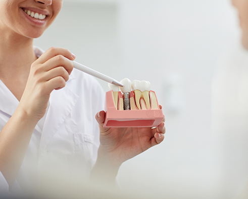 Dental professional demonstrating dental implant model, highlighting titanium post and natural-looking crowns, emphasizing dental implant benefits for tooth restoration.