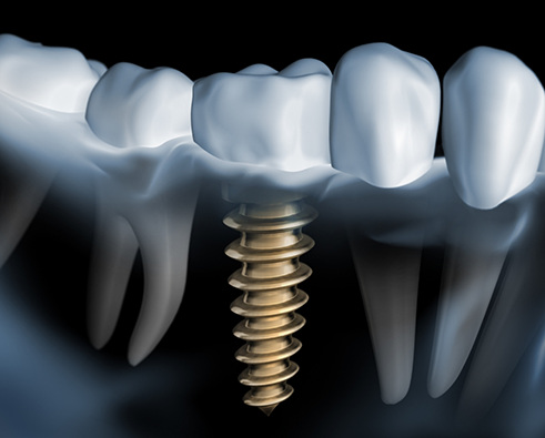 Dental implant illustration showing titanium post inserted into jawbone, supporting natural-looking teeth, highlighting tooth restoration benefits.
