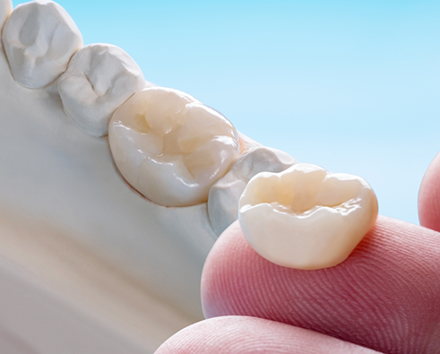 Dental crown held between fingers, showcasing tooth restoration, with natural appearance and fit over a model tooth, emphasizing restorative dentistry services at Kimberley Lane Cosmetic and Family Dentistry.