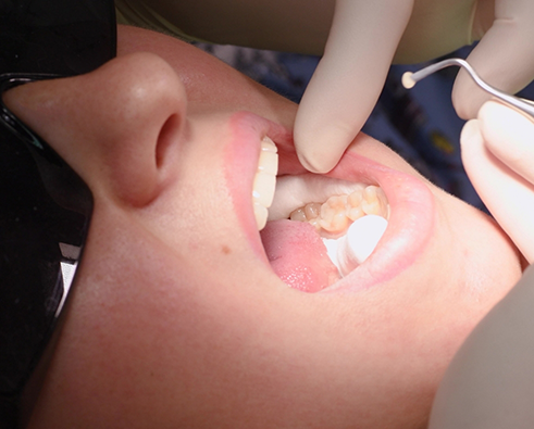 Patient receiving dental treatment, showcasing a dentist using tools for restorative dentistry, focusing on dental health and tooth restoration.