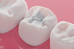 Tooth-colored fillings in dental cavities, showcasing modern restorative dentistry options for a natural smile.